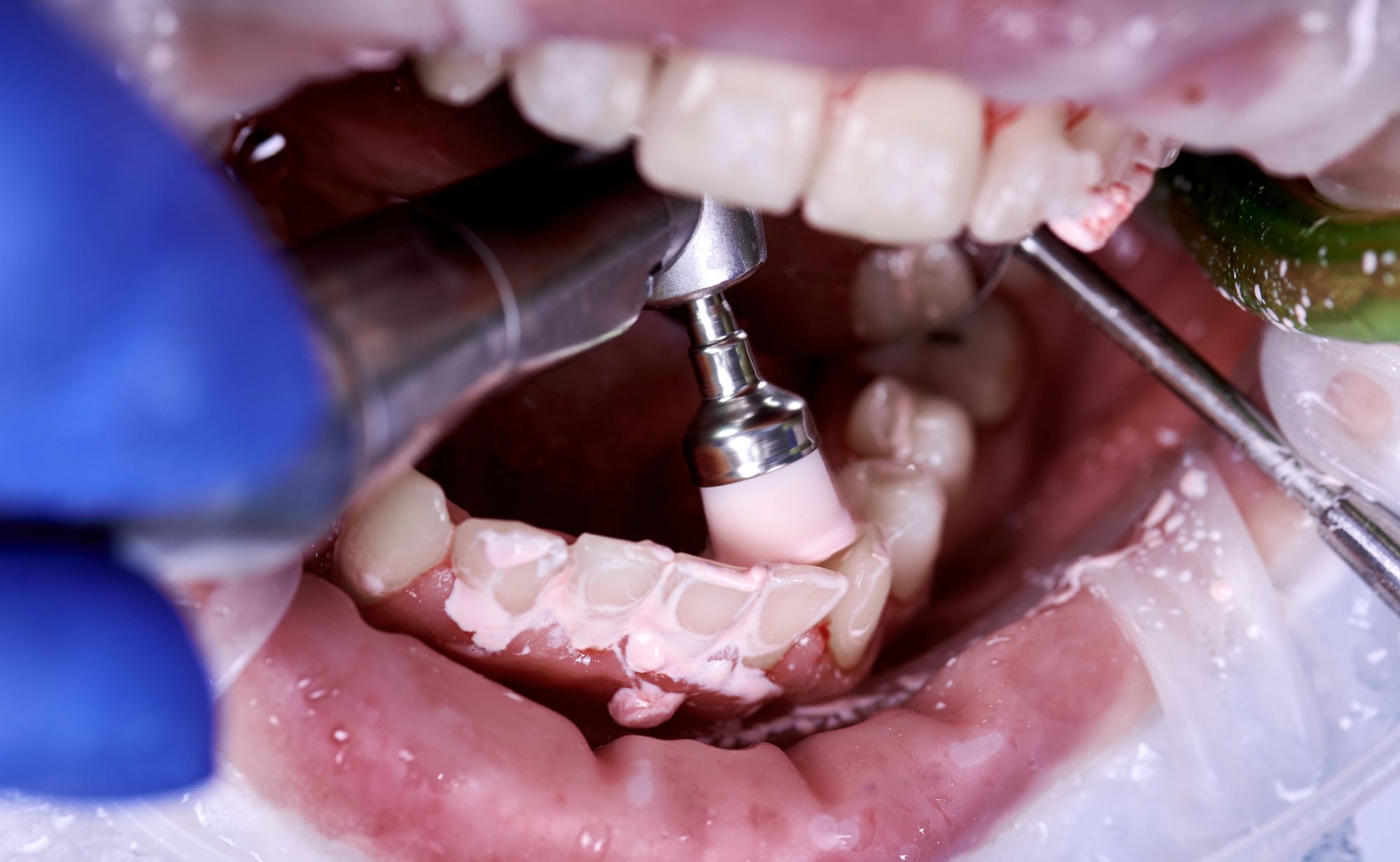 Danes je paradontologija zelo napredovala